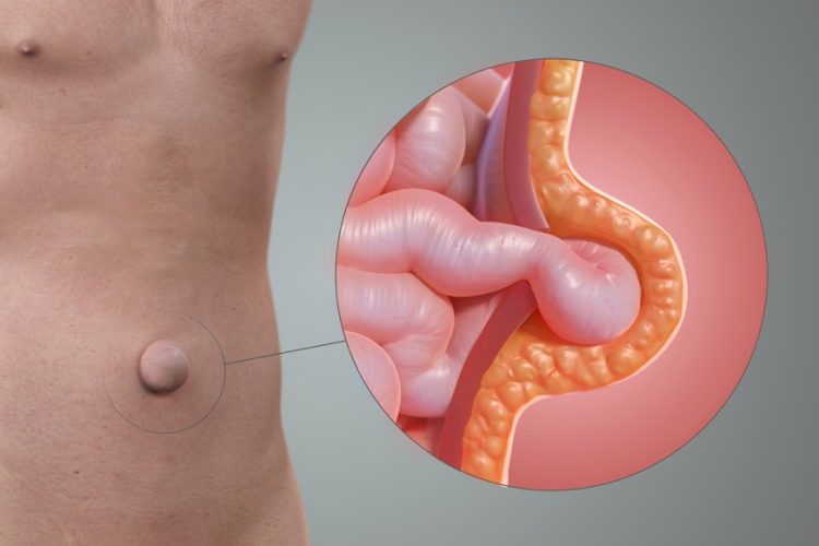 Apa Itu Hernia Umbilikalis