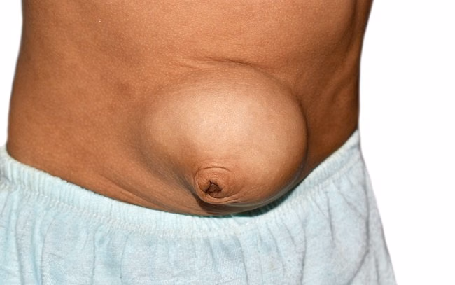 Hernia Umbilikalis: Penyebab, Gejala, dan Cara Mengobatinya